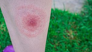 Lyme Hastalığı Tedavi Sonrası Sendroma Dönüşebilir