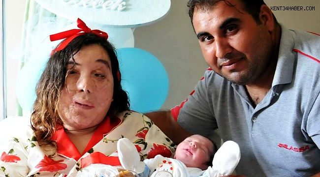 Yüz nakli beklerken aşık olup evlendiler