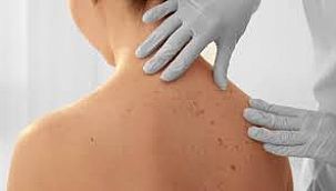 Soğuk Hava Kurdeşeni Tetikliyor